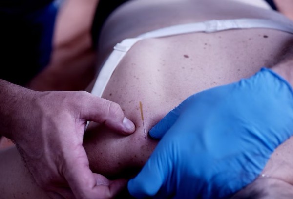 Pratique du dry needling — puncture sèche des points gâchettes