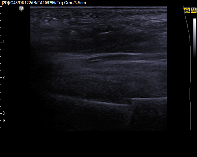échographie du pied fracture métatarse plantaire