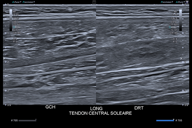 lésion du tendon central du soléaire longitudinal