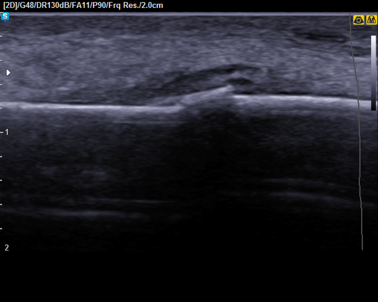 échographie du pied fracture métatarse dorsal