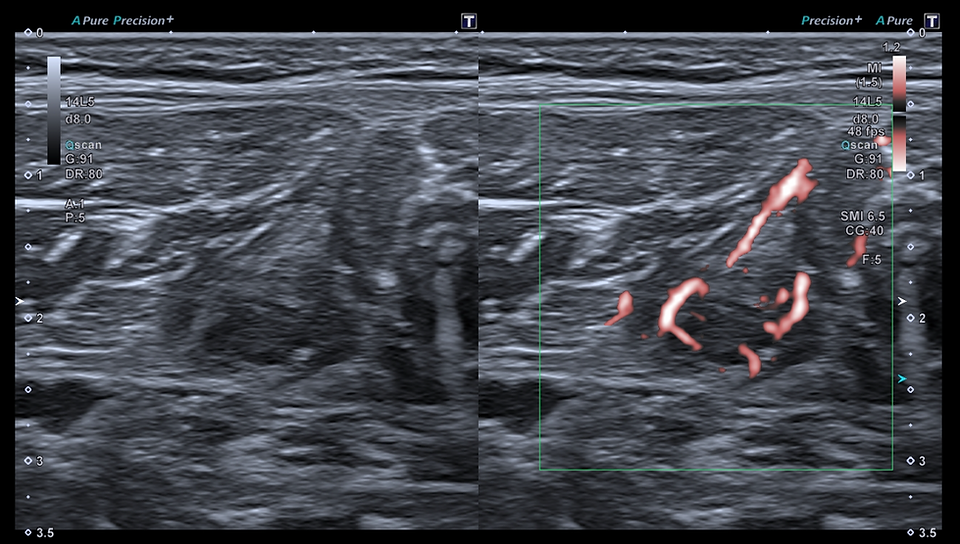 lésion du tendon central du soléaire dynamique
