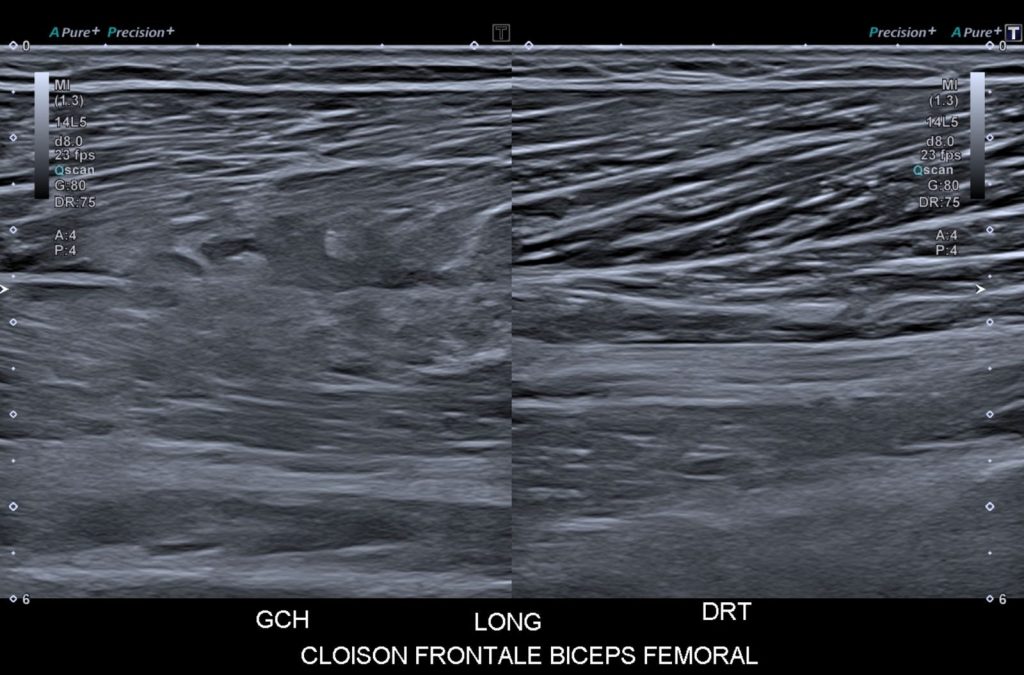 échographie lésion biceps fémoral axe long