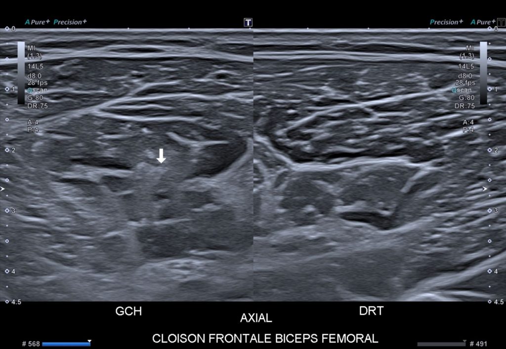 échographie lésion biceps fémoral axe court